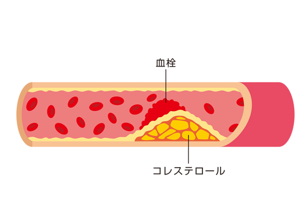 動脈硬化の説明図